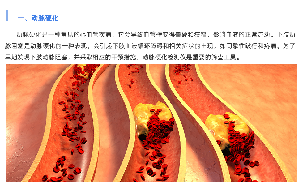 動(dòng)脈硬化檢測(cè)儀